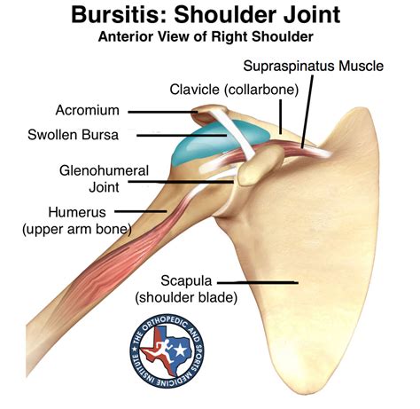 bursitis shoulder joint  orthopedic sports medicine institute