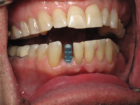 anterior teeth