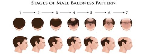 Dermatologist Treatment Of Male Pattern Baldness Mphl