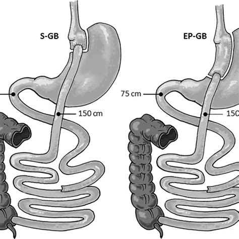 Diagrammatic Representation Of The One Anastomosis Gastric