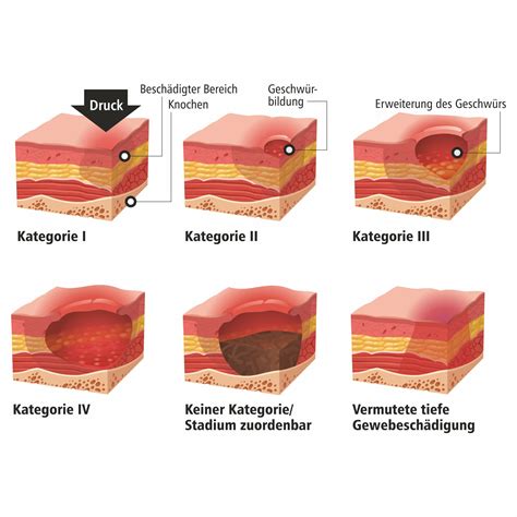 expertenstandard dekubitusprophylaxe  der pflege hygiene kolleg