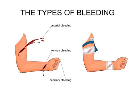 types  bleeding