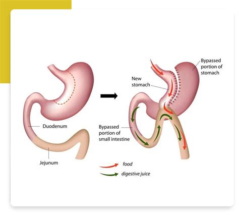 Laparoscopic Gastric Bypass Bmi Surgical