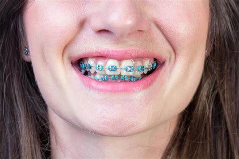 amazing benefits  braces ricard family dentistry