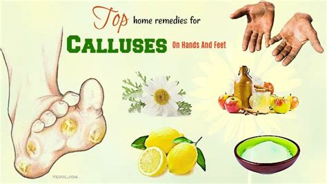 Top 30 Home Remedies For Calluses On Hands And Feet Page 2