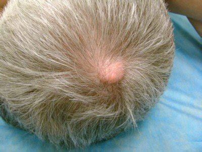 bump   head hurts  pressure  diagnosis treatment