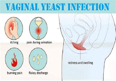 when treating a yeast infection does it burn homeopathic