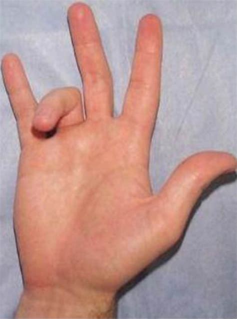 dedo en gatillo tenosinovitis estenosante limite en flexión de dedos en