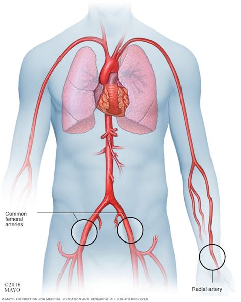 Cardiac Catheterization Procedure Approaches Mayo Clinic