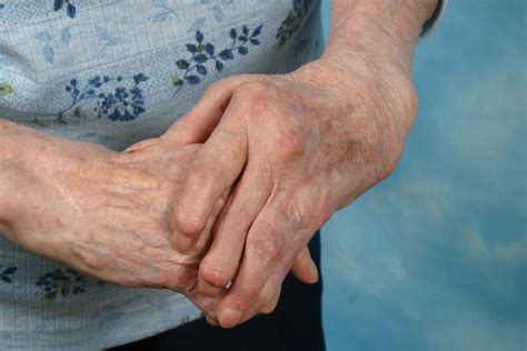 arthritis  hands symptoms treatment  home remedies