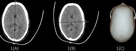 cureus establishment  cephalic index  cranial parameters  computed tomography