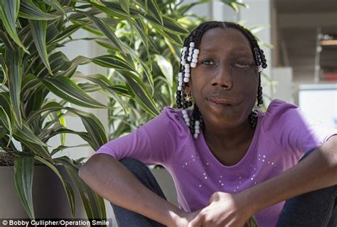haitian teen has four pound tumor removed from her face daily mail online