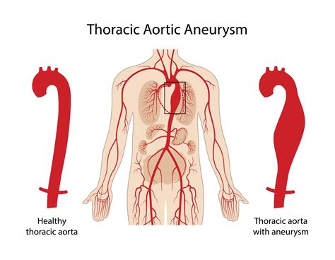 thoracic aneurysm dissection uwmtap