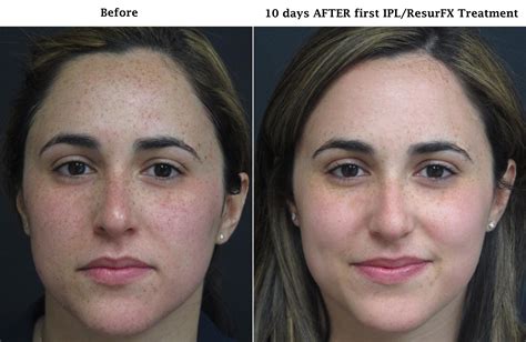ipl photofacial and skin rejuvenation dark spot removal