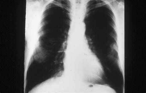Asbestos Related Pulmonary Disorders The Clinical Advisor