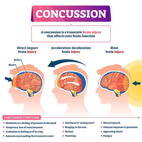 concussion vector health