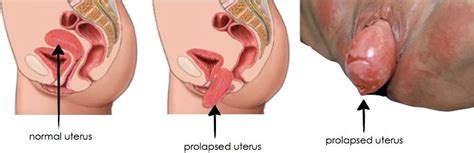 What Is Uterine Prolapse Get The Best Health Tips Being Postiv