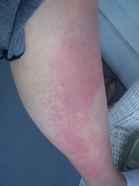 developed  rash   legs   itchy   hours