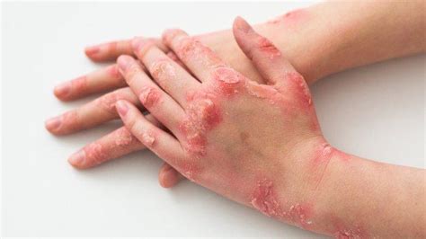 kenali   psoriasis beserta jenisnya kondisi  sebabkan kulit