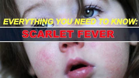 These Are The Symptoms Of Scarlet Fever And How To Stop It Spreading