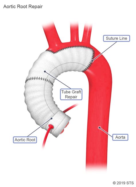 thoracic aortic aneurysm newport cardiac thoracic surgery