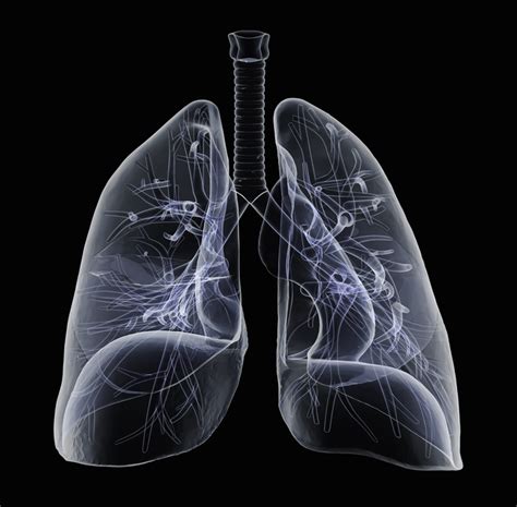 infarkt der lunge gesundheitsi