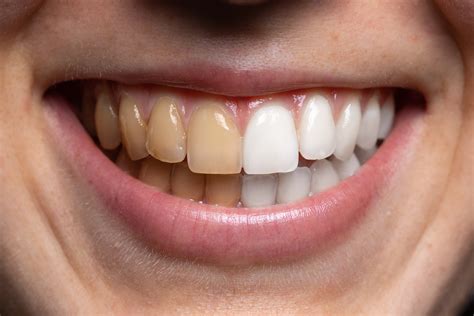 cut   bad habits  brighter  whiter teeth
