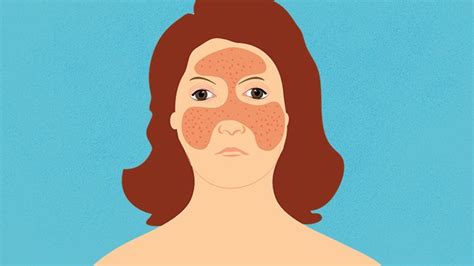 How To Identify Rashes And Other Lupus Skin Symptoms Everyday Health