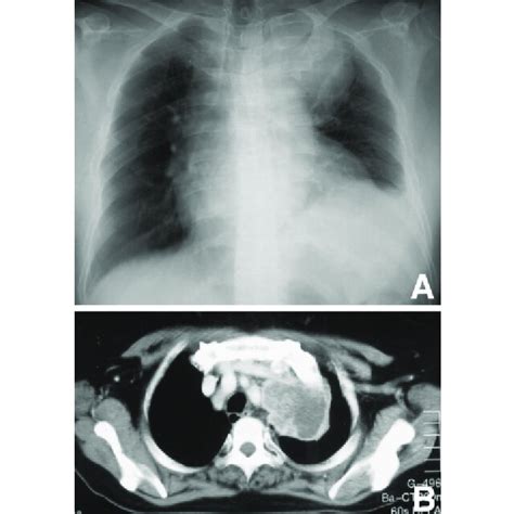 A Chest Radiograph Showing A Tumor In The Upper Lobe Of The Left Lung