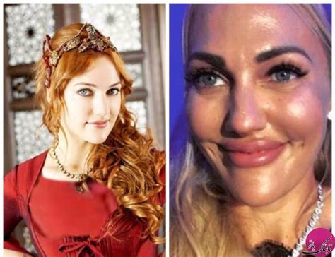 چهره ی جدید بازیگر معروف ترکیه ای پس از جراحی زیبایی صدای