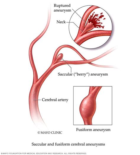 brain aneurysm symptoms