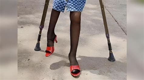 Beautiful Polio Girl Has Short Leg And Walks With Crutches 3 😍 ️