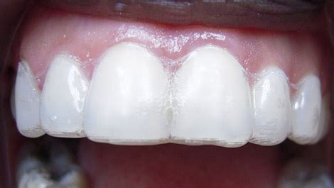 invisalign elite preferred provider  marin ca orthodontists