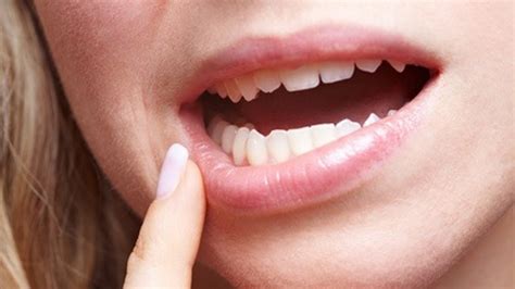 aphte bouche langue gencive traitement et cause