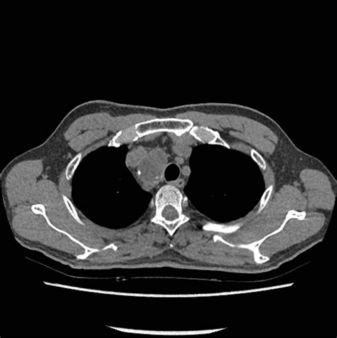 A Case Of Right Paratracheal Ectopic Thyroid Mimicking Metastasis On