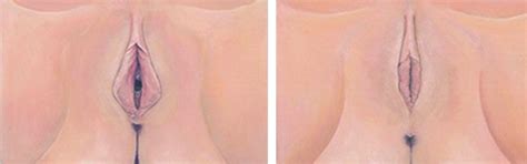designer vagina before and after
