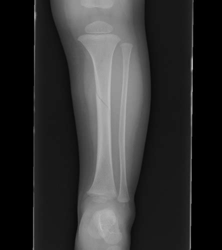 tibial fractures  bone school