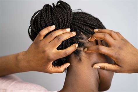 scalp atopic dermatitis   skin conditions