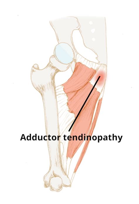 Adductor Tendinopathy Circle Integrated Care