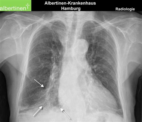 roe thorax mittellappen atelektase pa doccheck