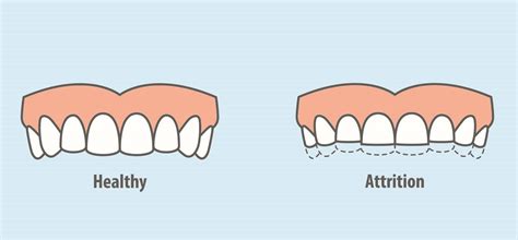 dental attrition
