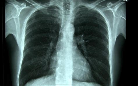 krijgen zware rokers een scan om fatale longkanker te voorkomen dagblad van het noorden