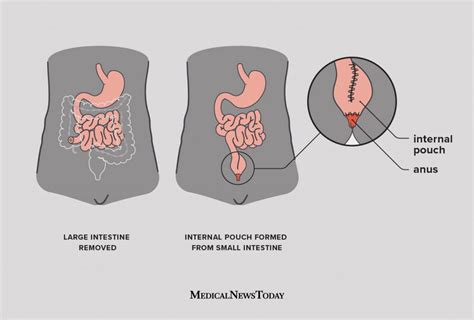 Ulcerative Colitis Surgery Procedure Recovery And What To Expect
