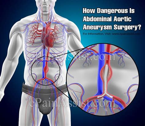 dangerous  abdominal aortic aneurysm surgery abdominal aortic