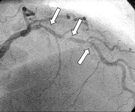 percutaneous coronary intervention  history  development  bmj