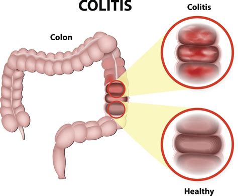 inflammatory bowel disease ibd  irritable bowel syndrome ibs