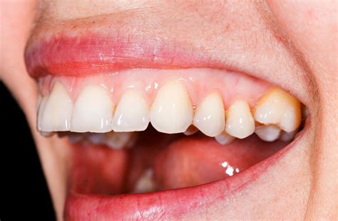 pale gums  symptoms treatment  warning signs