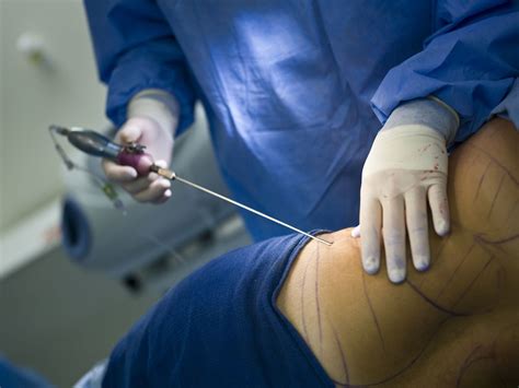 overview  recovery  liposuction