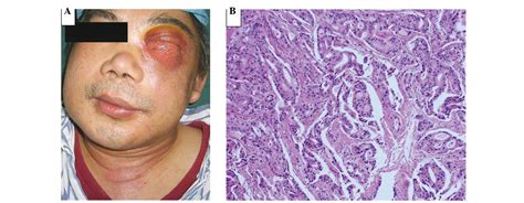 differential diagnosis   carcinoma   maxillary sinus