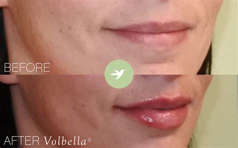 juvederm volbella for lips pump up the volume skin by lovely